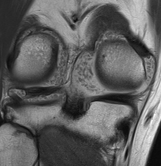 MRI Knee Synovial Chondromatosis
